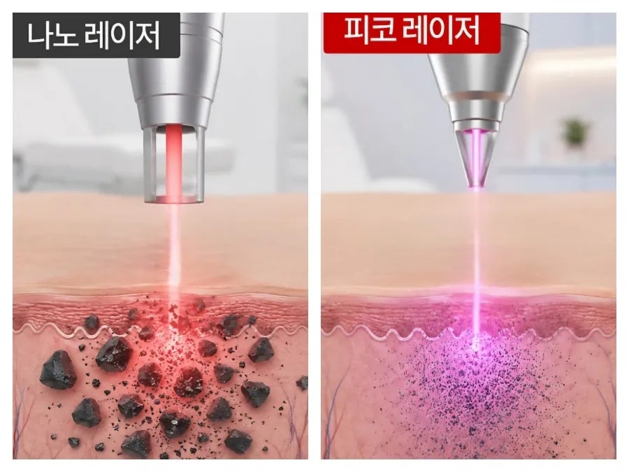 피코 레이저
