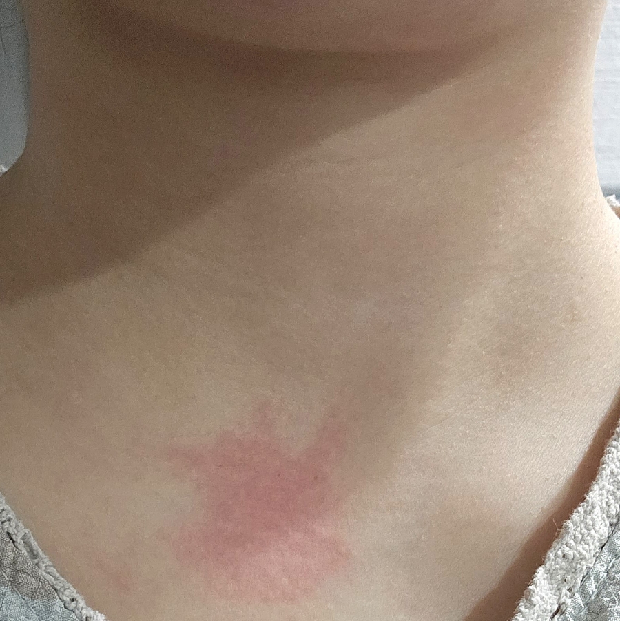 고양이 알레르기 때문에 시작한 퀘르세틴 브로멜라인｜지르텍만으로 부족했던 날들의 영양제 후기