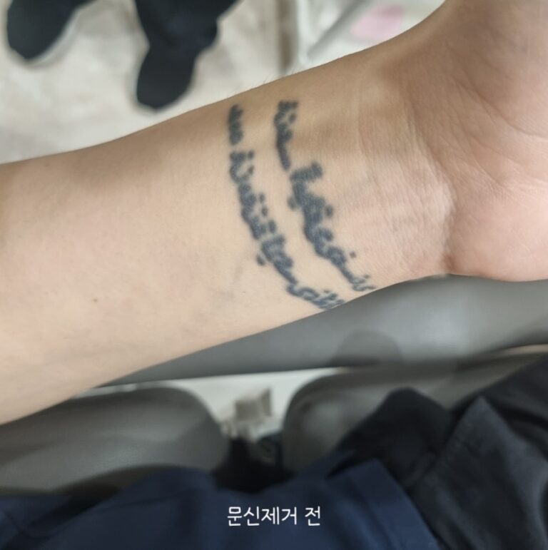 인천 계양 문신제거 2회차｜피코레이저 받고 얼마나 지워졌을까? 솔직 후기