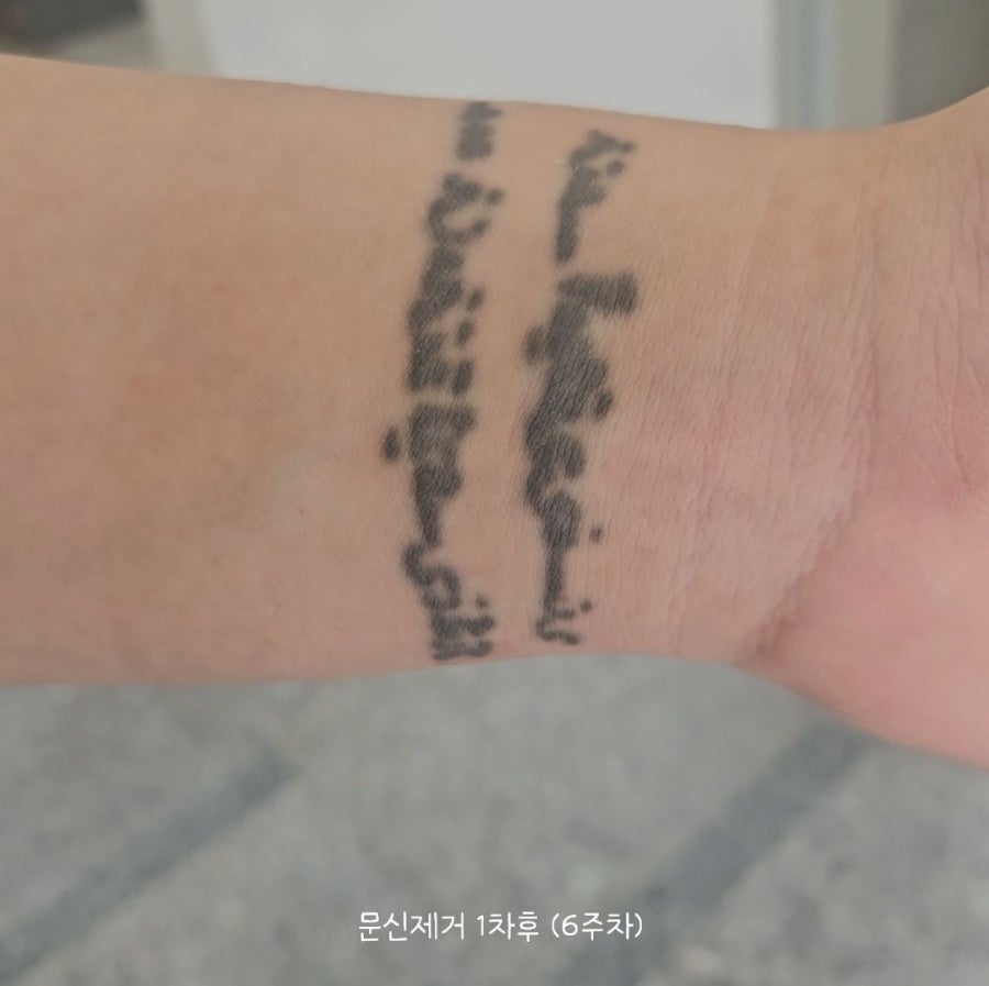 인천 계양 문신제거 2회차｜피코레이저 받고 얼마나 지워졌을까? 솔직 후기