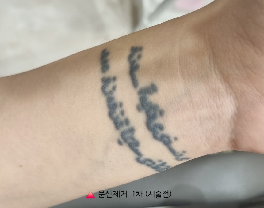 인천 계양 문신제거 2회차｜피코레이저 받고 얼마나 지워졌을까? 솔직 후기