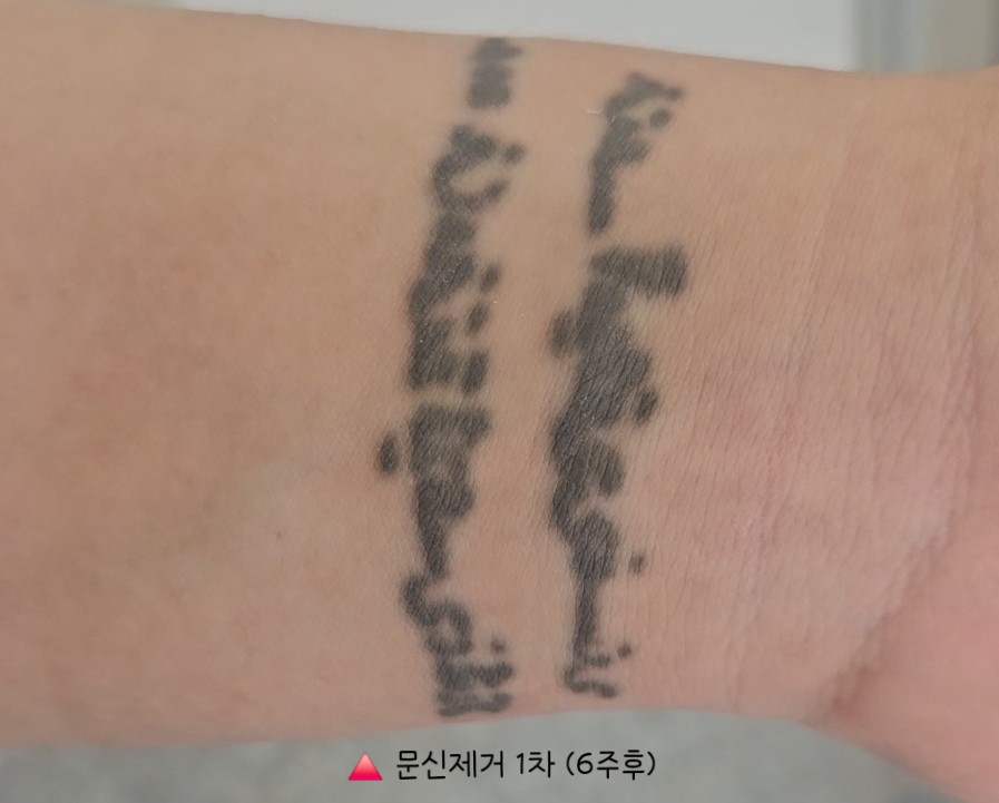 인천 계양 문신제거 2회차｜피코레이저 받고 얼마나 지워졌을까? 솔직 후기