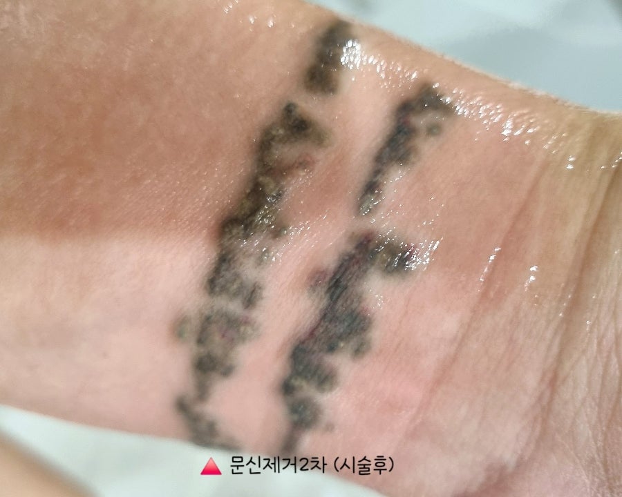 인천 계양 문신제거 2회차｜피코레이저 받고 얼마나 지워졌을까? 솔직 후기